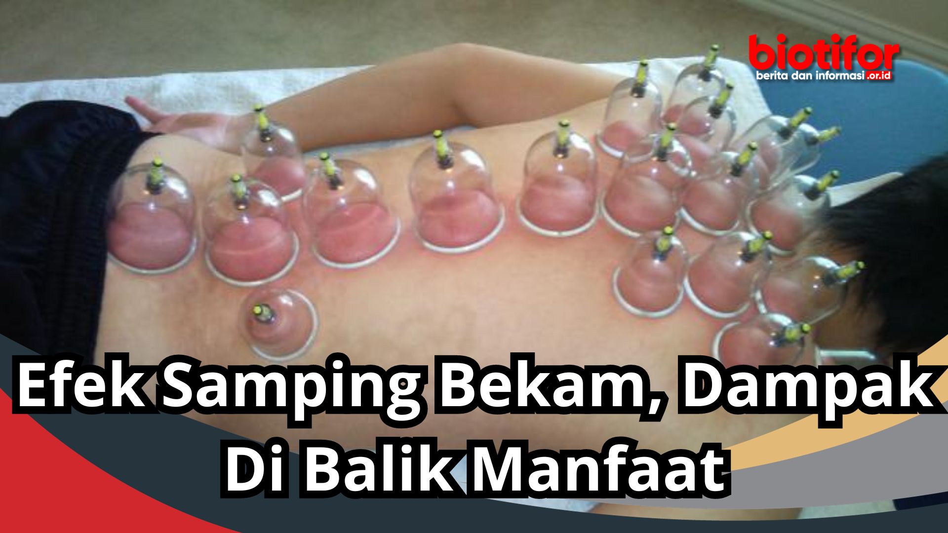 Efek Samping Bekam, Dampak Di Balik Manfaat