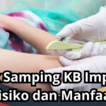 Efek Samping KB Implan