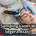 efek samping laser wajah